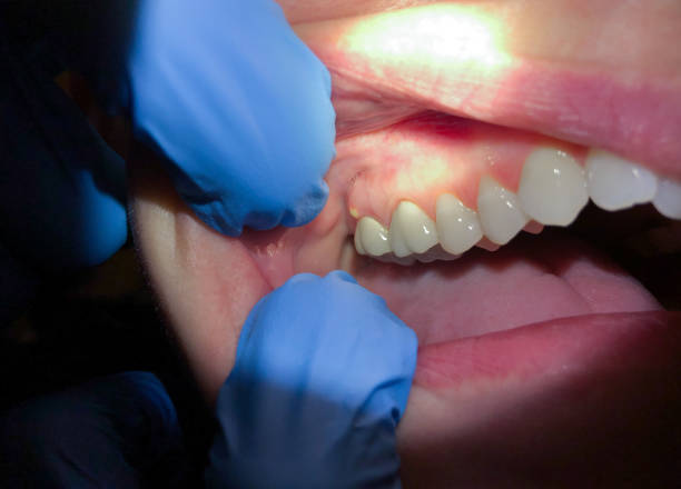 Best Knocked-Out Tooth (Avulsed Tooth) Treatment in Melwood, MD